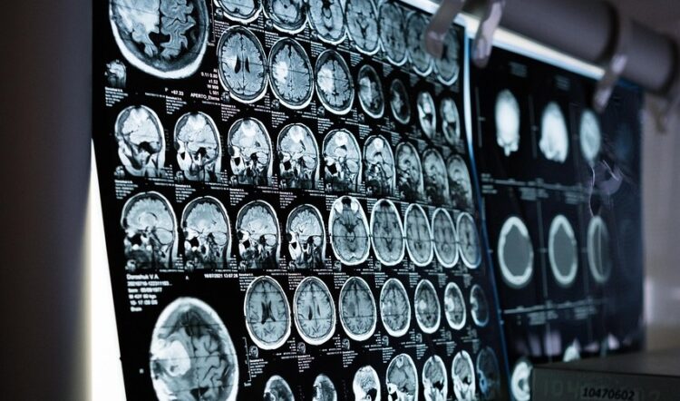 Lekarz: Udar mózgu coraz częściej dotyka ludzi młodych