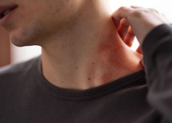 [AKTUALIZACJA] Już 26 przypadków odry na Podkarpaciu